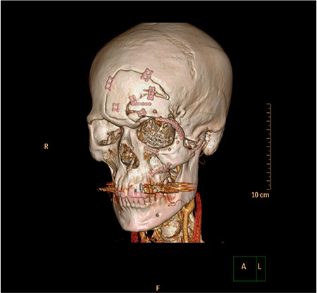 Bilde 5: Postoperativt CT bilde kasus 1.